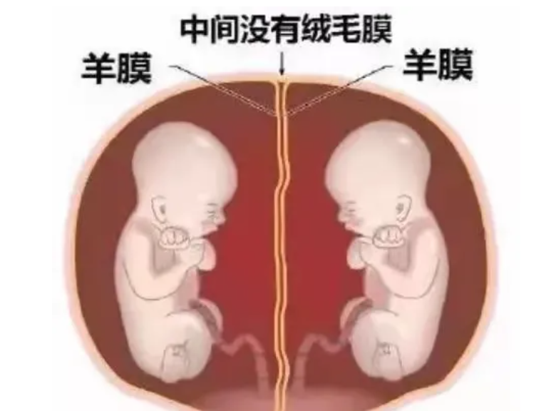 37周足月分娩單絨雙羊雙胞胎是一種什么體驗？